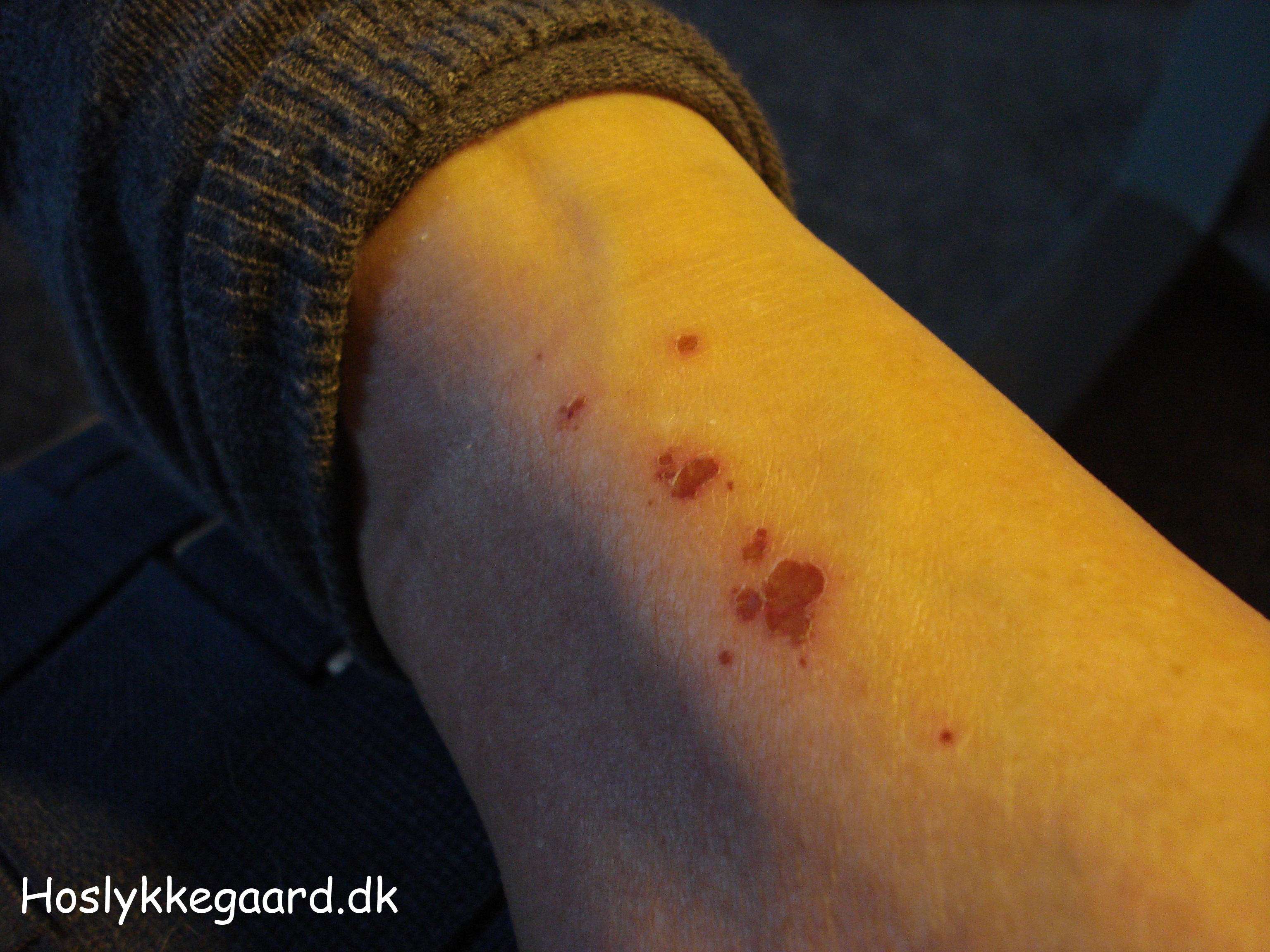 sår på skinneben sår på skinneben